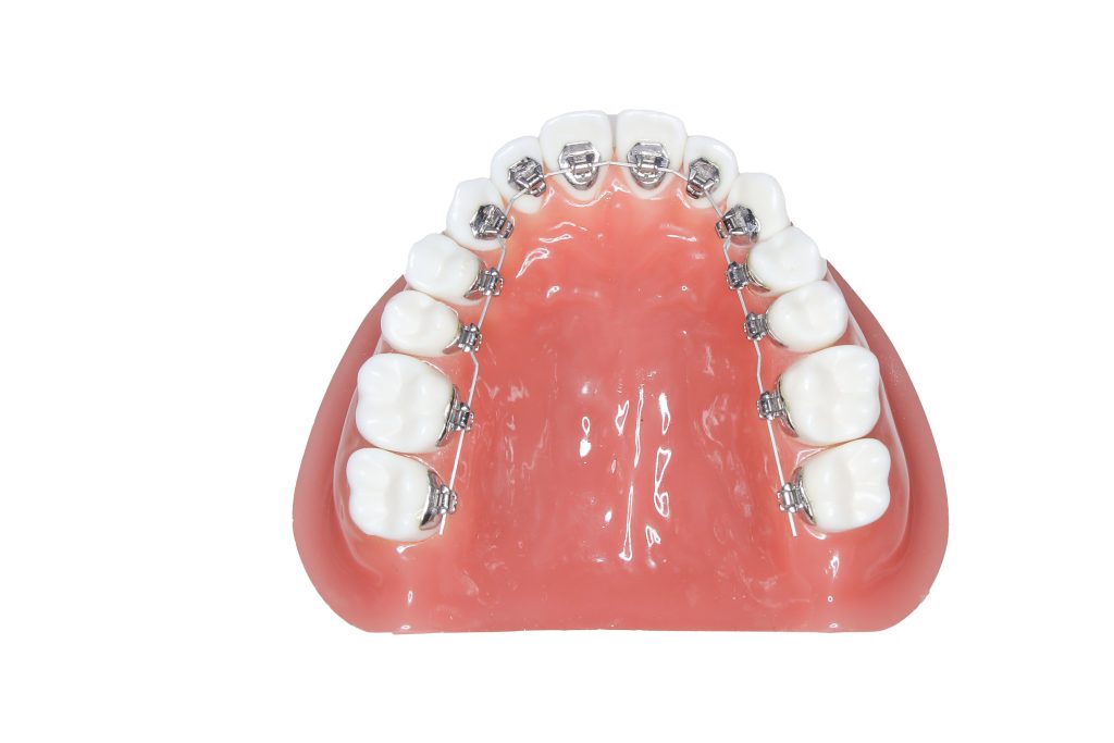 裏側矯正（舌側矯正） | 諏訪矯正・予防歯科 4S｜フォースは諏訪 